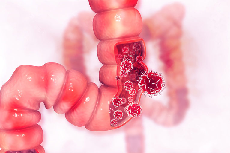 3D illustration of cancer in colon