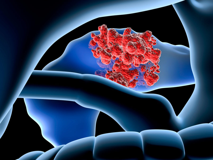 Illustration eines Tumors in der Bauchspeicheldrüse