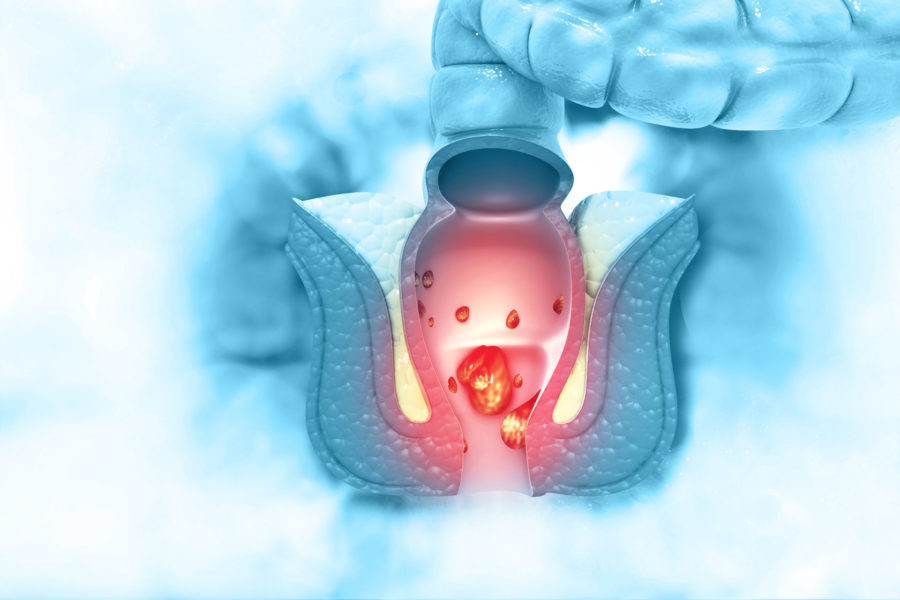 Tumor in rectum