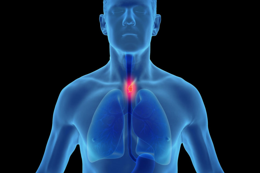 Illustration of a tumor in the esophagus