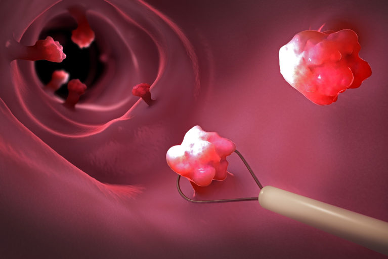 Removal of an early carcinoma in the esophagus